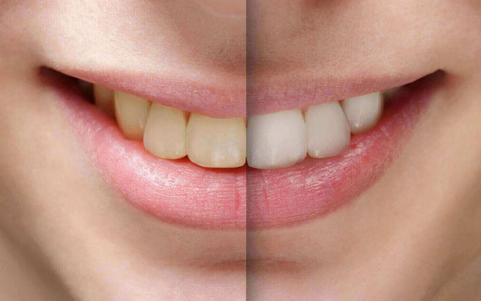 Tẩy trắng răng: Quy trình và chi phí mới nhất 2024