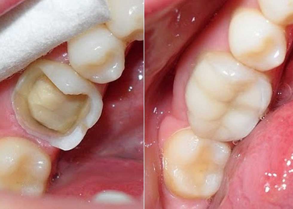 Trám răng thẩm mỹ là gì? 3 yếu tố ảnh hưởng đến chi phí