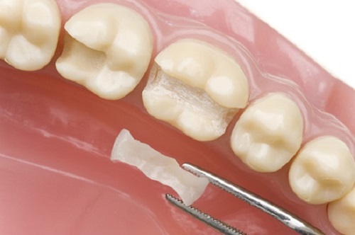 Trám răng thẩm mỹ là gì? 3 yếu tố ảnh hưởng đến chi phí