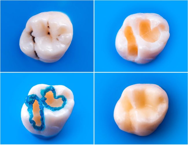 Trám răng thẩm mỹ là gì? 3 yếu tố ảnh hưởng đến chi phí