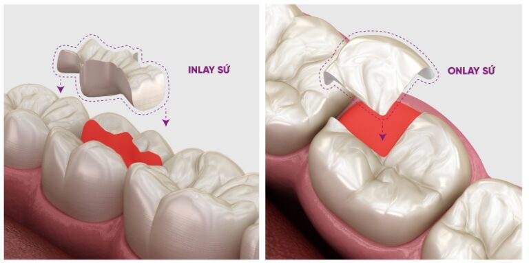 Trám răng thẩm mỹ là gì? 3 yếu tố ảnh hưởng đến chi phí