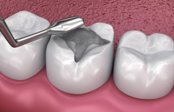Trám răng và lấy tủy giá bao nhiêu? Bảng giá chi tiết mới nhất 2024