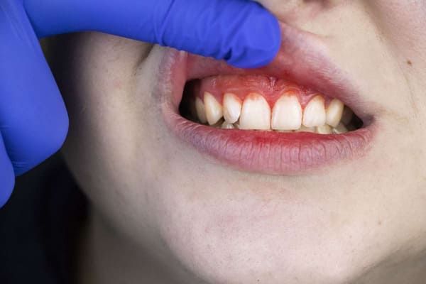 Viêm lợi là gì? Nguyên nhân và 3 cách điều trị hiệu quả