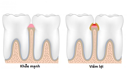 Viêm lợi là gì? Nguyên nhân và 3 cách điều trị hiệu quả