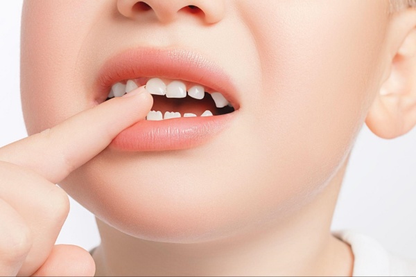 Gãy răng và 5 phương pháp phục hồi hiệu quả nhất