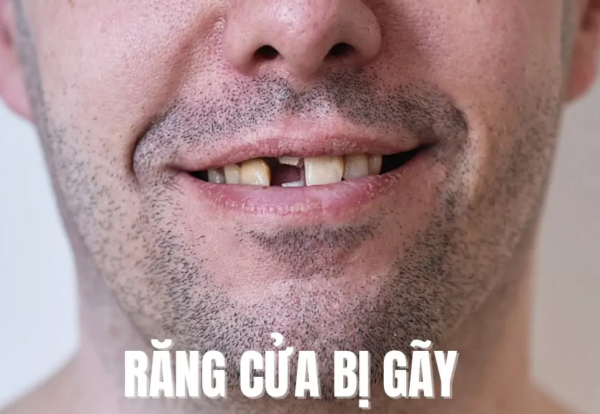 Gãy răng và 5 phương pháp phục hồi hiệu quả nhất