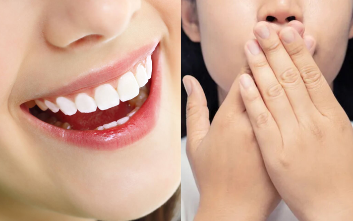 Hôi miệng: Nguyên nhân và 5 cách điều trị hiệu quả nhất