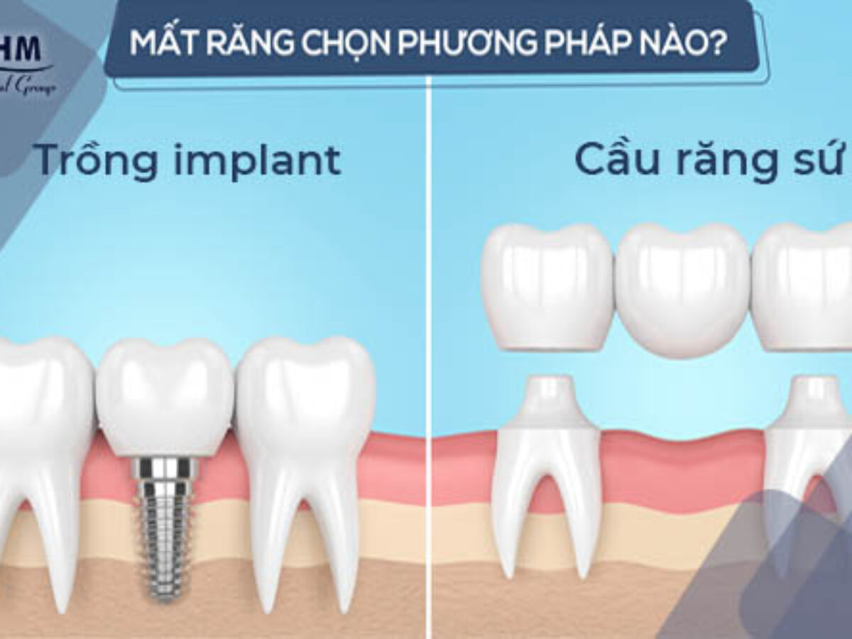 Mất răng và 4 giải pháp phục hồi tốt nhất