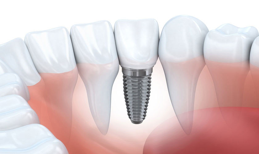 Mất răng và 4 giải pháp phục hồi tốt nhất