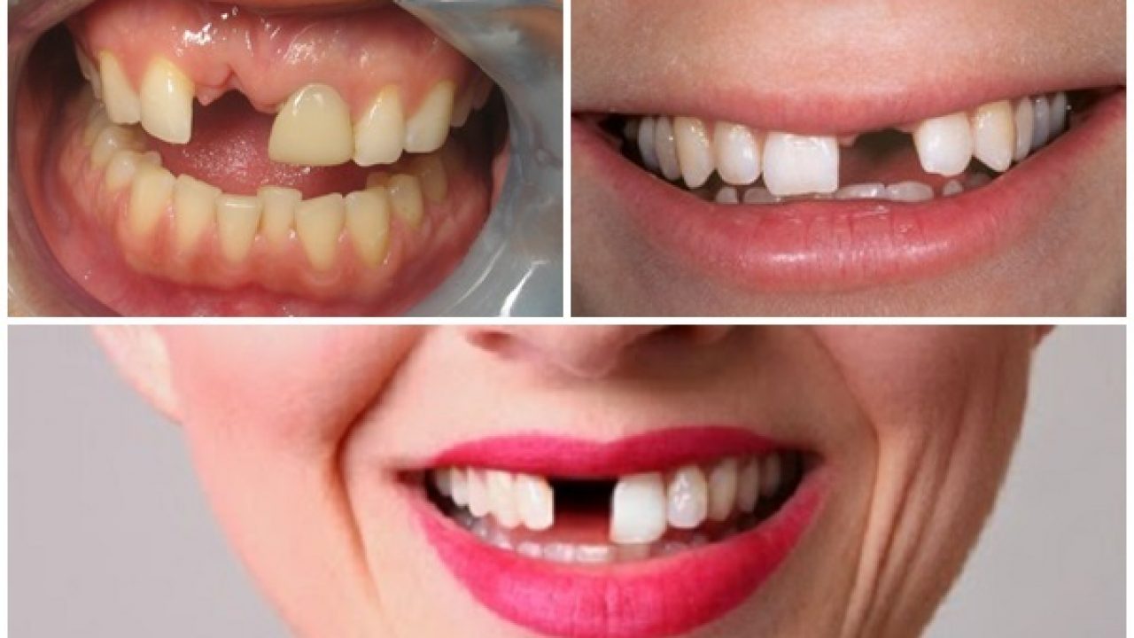 Mất răng và 4 giải pháp phục hồi tốt nhất