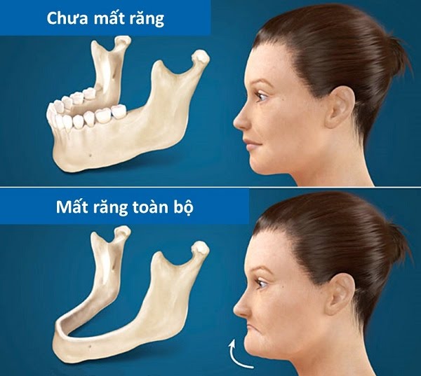 Mất răng và 4 giải pháp phục hồi tốt nhất