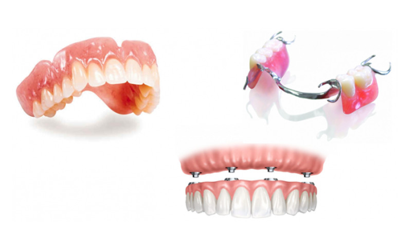 Răng giả là gì? có mấy loại và cách phân biệt mới nhất 2024