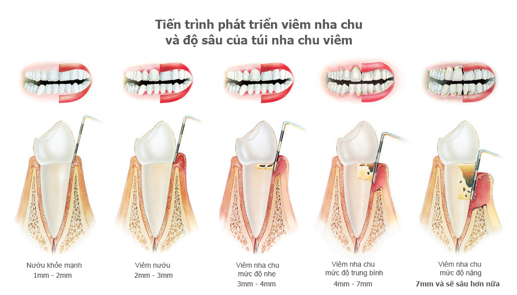 Răng nhạy cảm là gì: Nguyên nhân và 5 cách khắc phục