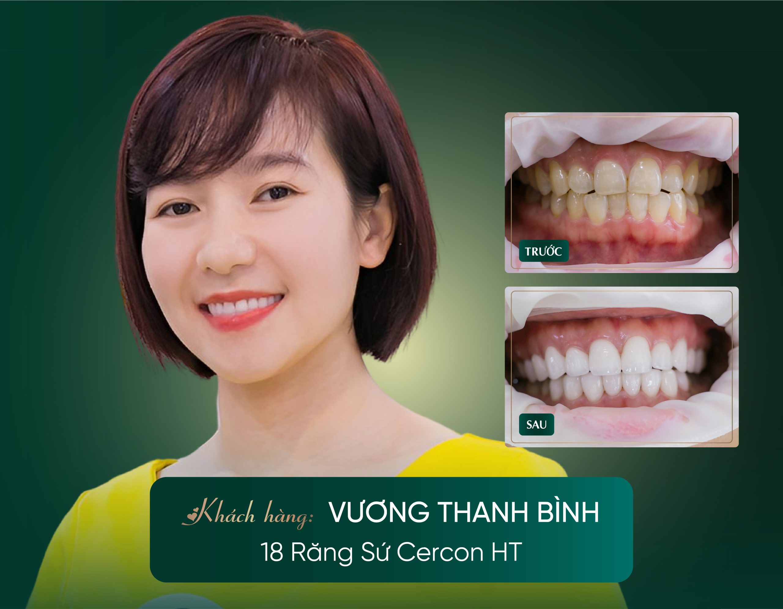 Răng sứ Cercon và 5 lợi ích vượt trội bạn cần biết