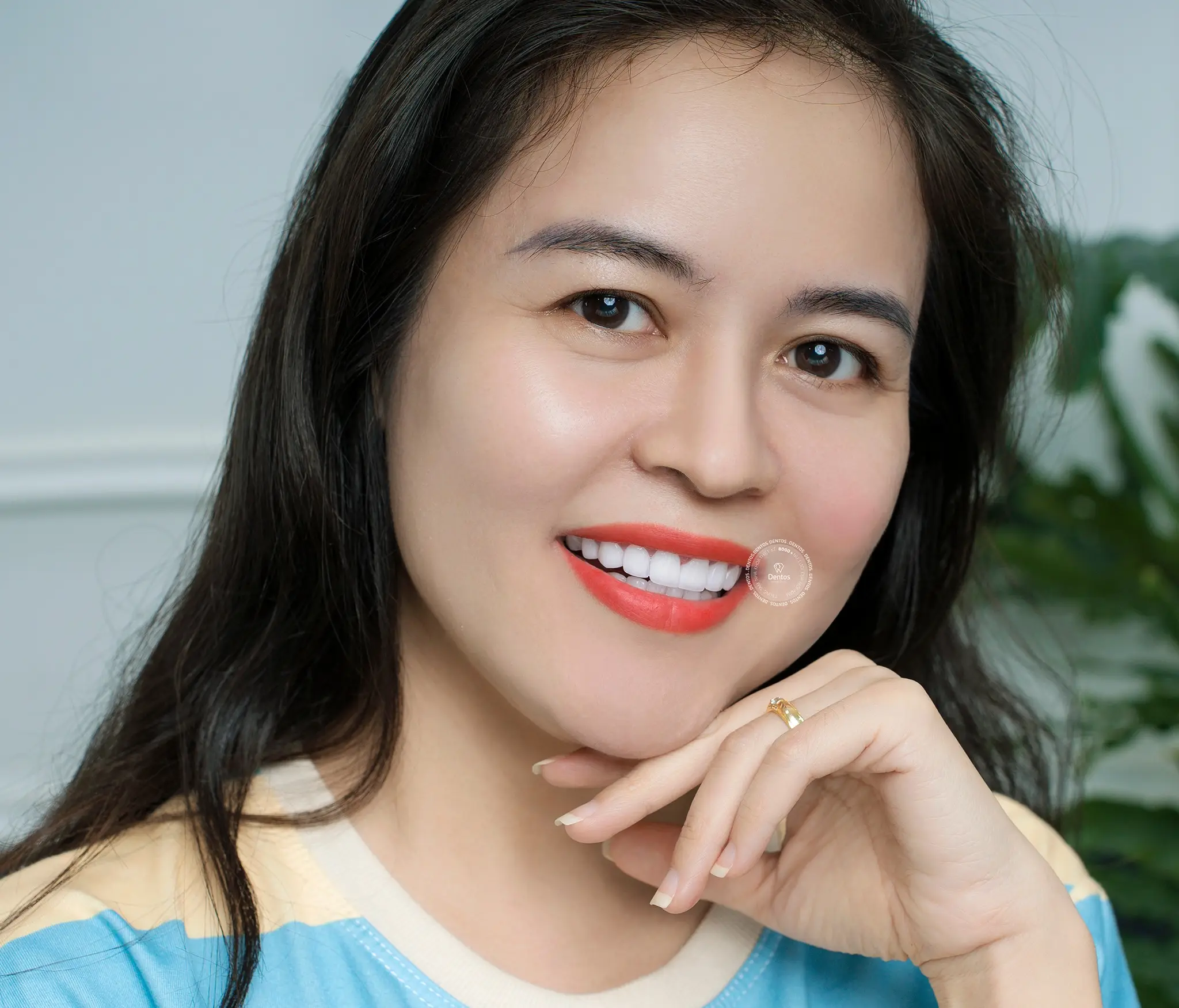 Răng sứ DDBIO: 5 ưu điểm vượt trội và quy trình thực hiện