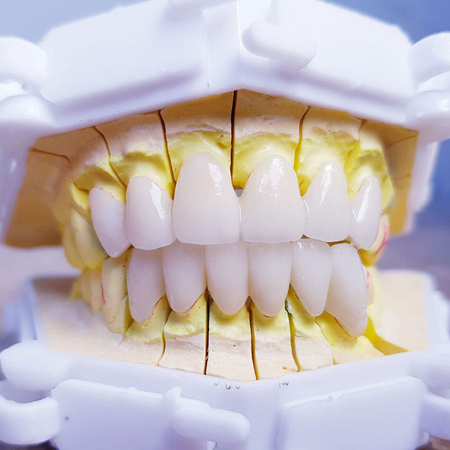Răng sứ Lava: 6 ưu điểm vượt trội và quy trình thực hiện mới nhất