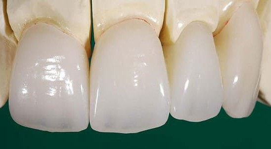 Răng sứ Lava: 6 ưu điểm vượt trội và quy trình thực hiện mới nhất
