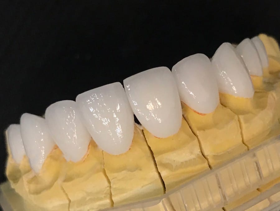 Tìm hiểu về răng sứ Nacera và 5 ưu điểm nổi bật