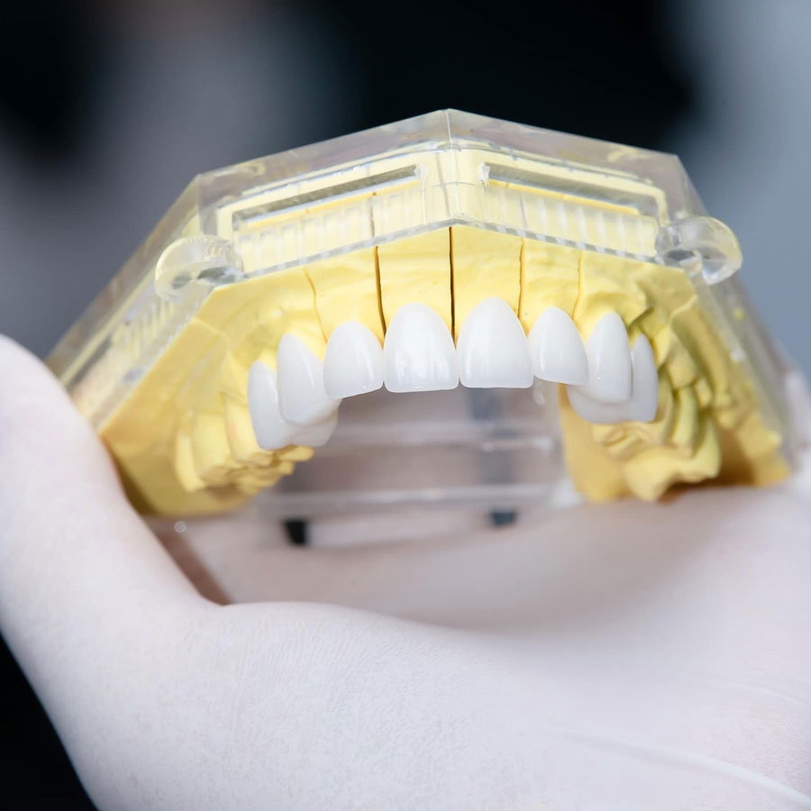 Tất tần tật về Răng sứ Orodent và 5 lợi ích vượt trội