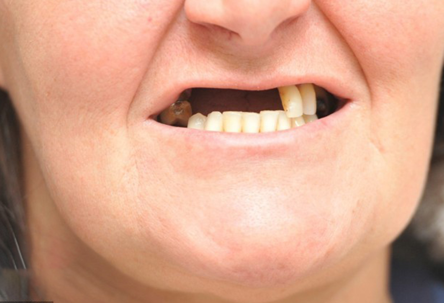 Tiêu xương hàm: Nguyên nhân và 3 phương pháp điều trị hiệu quả