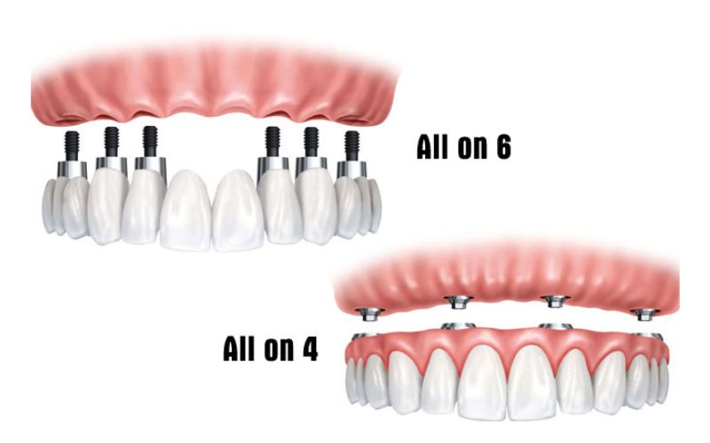 Trụ implant nào tốt nhất? 6 thương hiệu hàng đầu bạn nên biết