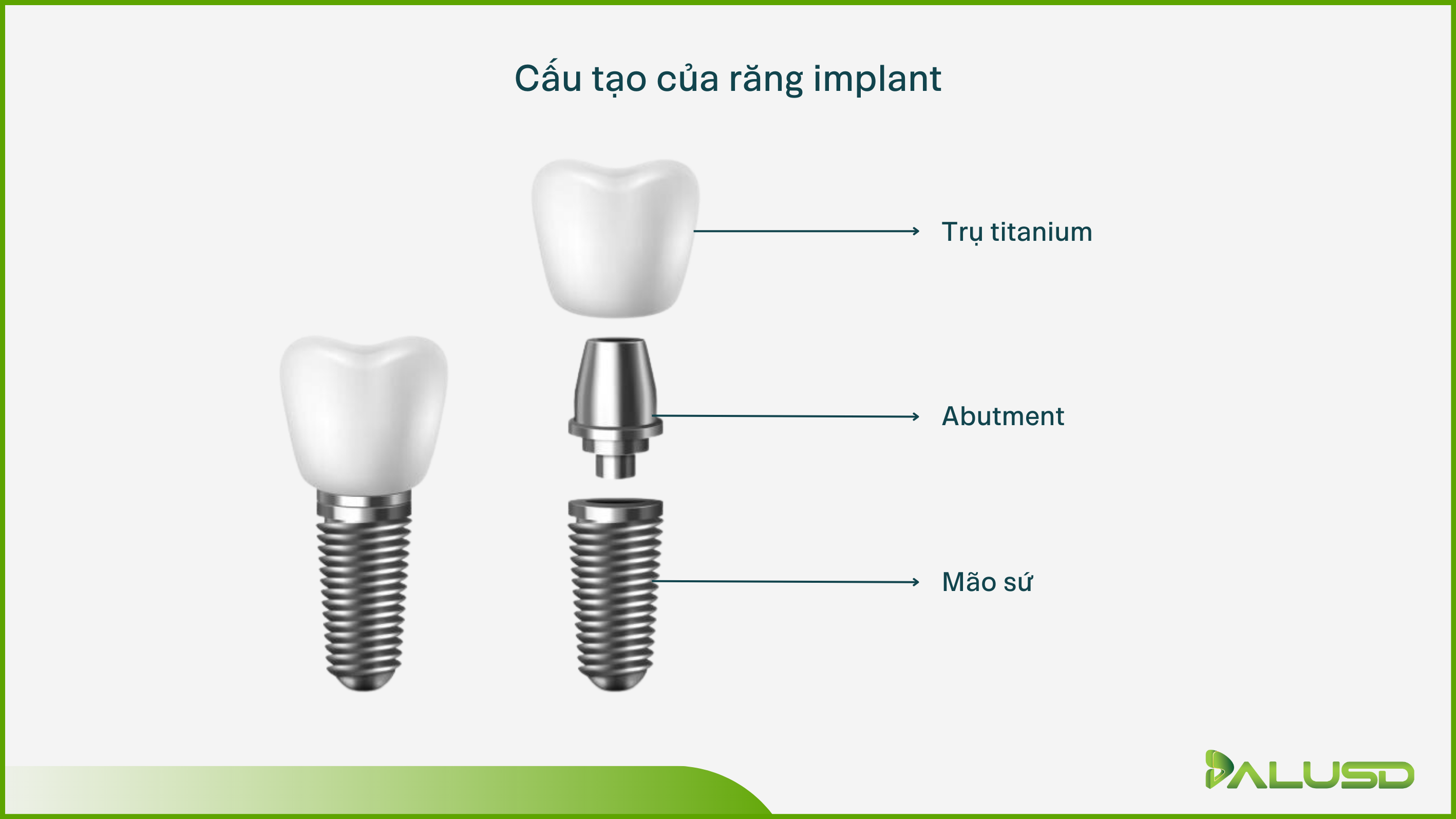 Trụ implant nào tốt nhất? 6 thương hiệu hàng đầu bạn nên biết