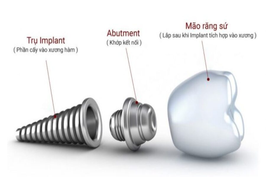 Trụ implant nào tốt nhất? 6 thương hiệu hàng đầu bạn nên biết