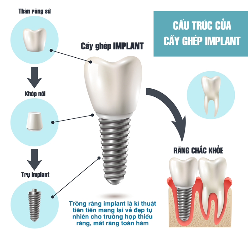 Trụ implant SIC và 5 lý do nên chọn cho phục hình răng