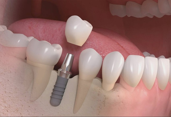 Trụ implant SIC và 5 lý do nên chọn cho phục hình răng