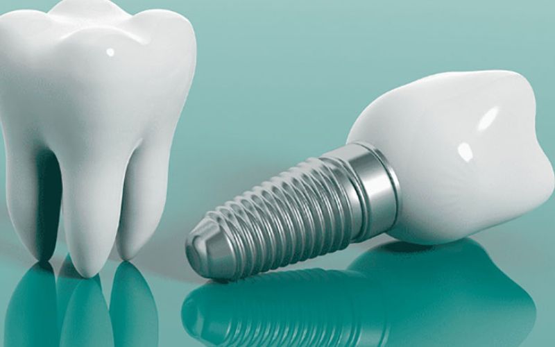 Trụ implant SIC và 5 lý do nên chọn cho phục hình răng