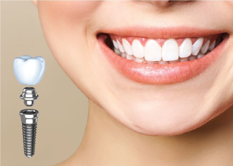 Trụ implant SIC và 5 lý do nên chọn cho phục hình răng
