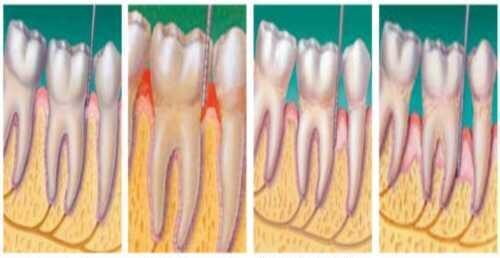 Tụt nướu là gì: Nguyên nhân và 4 phương pháp điều trị hiệu quả