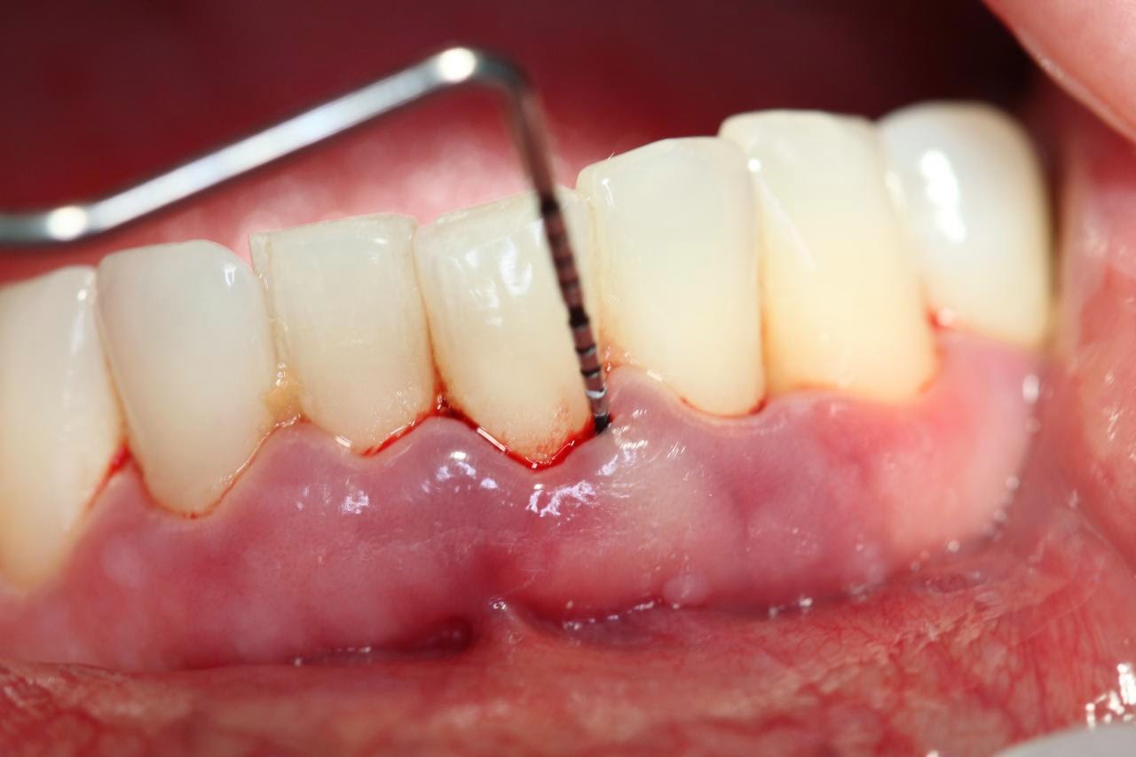 Tụt nướu là gì: Nguyên nhân và 4 phương pháp điều trị hiệu quả