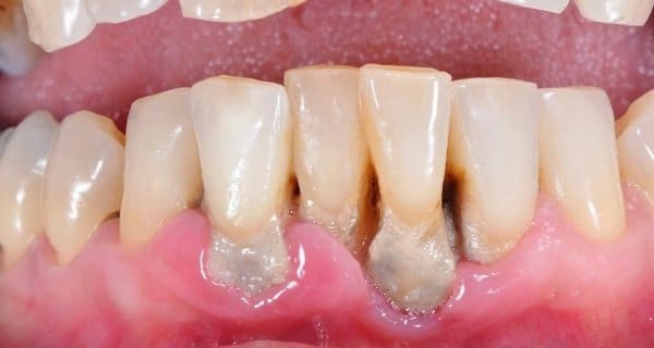 Tụt nướu là gì: Nguyên nhân và 4 phương pháp điều trị hiệu quả