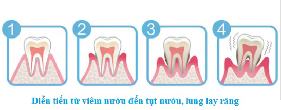 Tụt nướu là gì: Nguyên nhân và 4 phương pháp điều trị hiệu quả