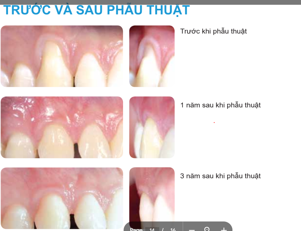 Tụt nướu là gì: Nguyên nhân và 4 phương pháp điều trị hiệu quả