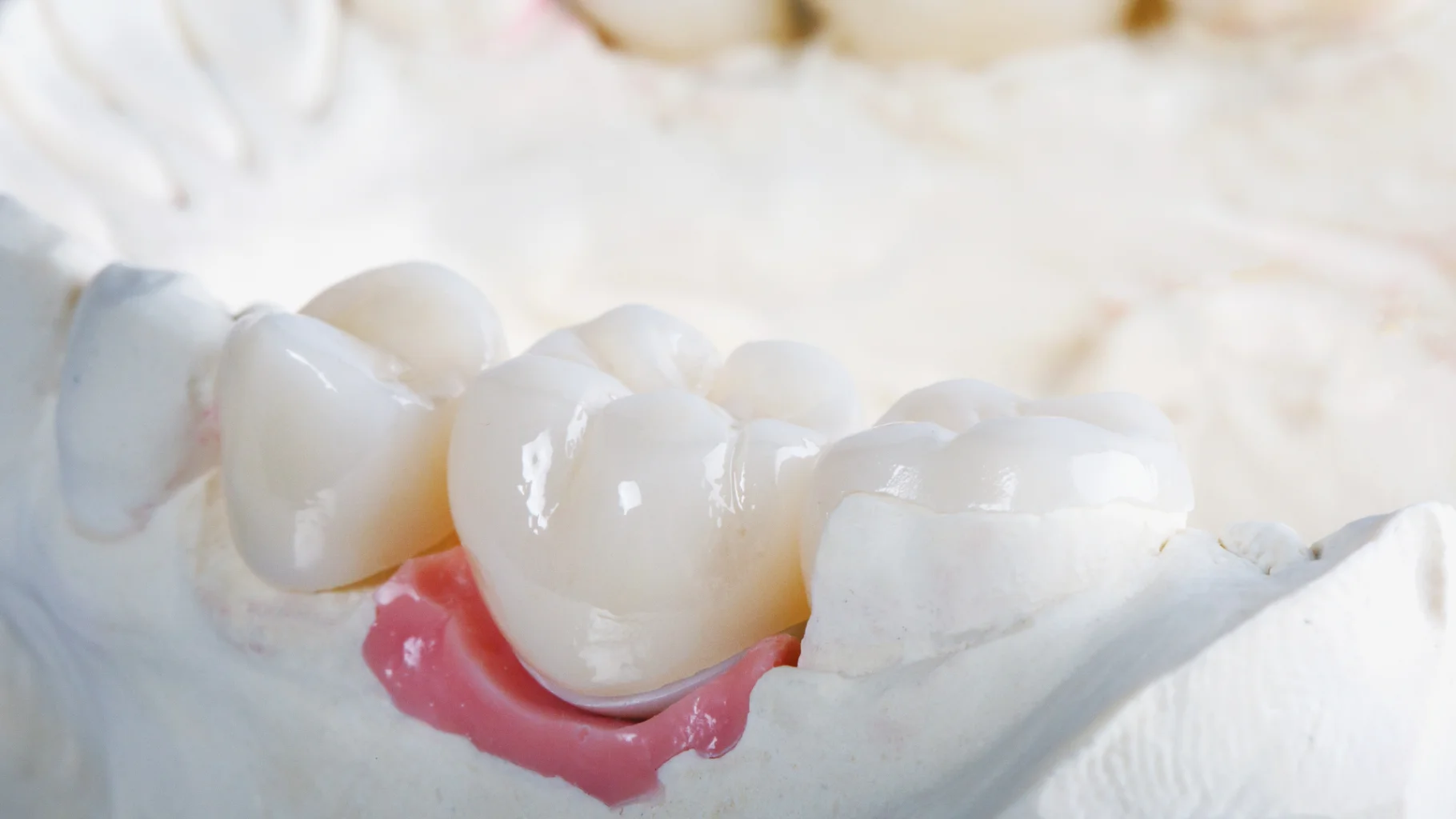 Tụt nướu là gì: Nguyên nhân và 4 phương pháp điều trị hiệu quả