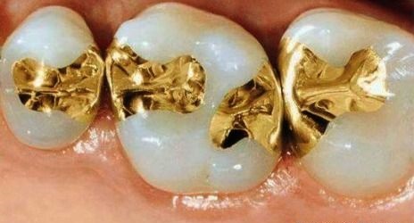 Trám răng bằng Inlay/Onlay và 5 điều cần biết