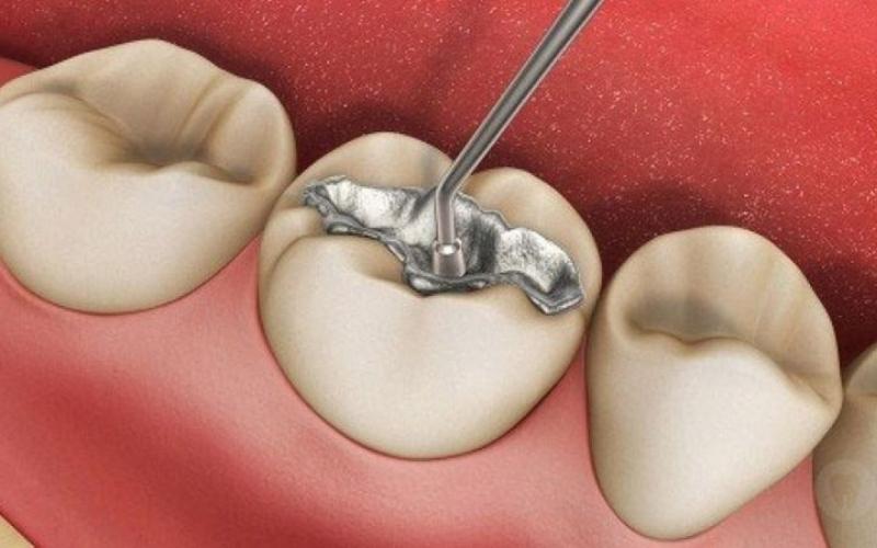 Trám răng cho người già như thế nào được cập nhật mới nhất 2024
