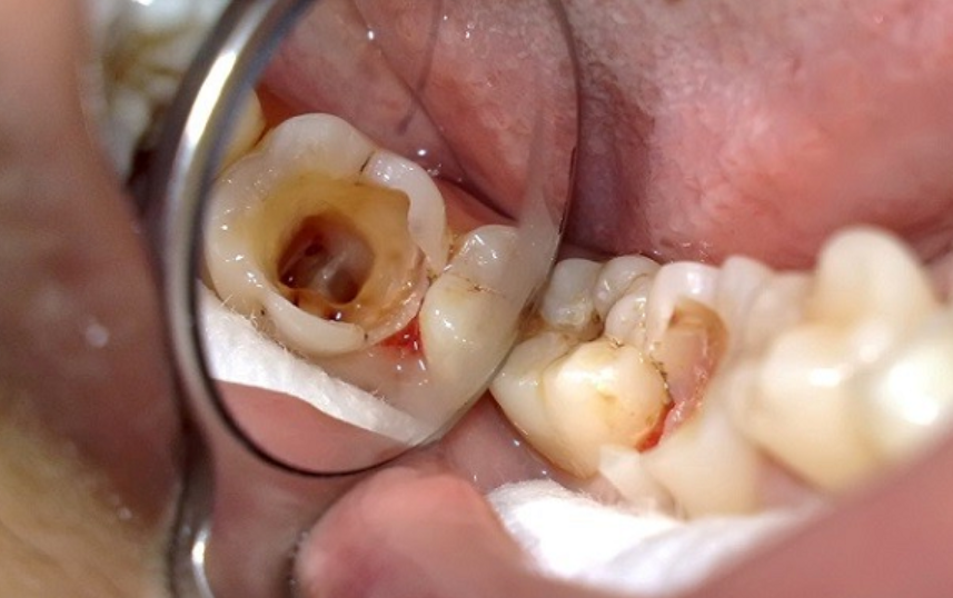 Trám răng cho người già như thế nào được cập nhật mới nhất 2024