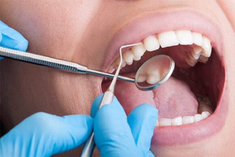 Trám răng cho người trưởng thành - Quy trình và giá thành mới nhất 2024