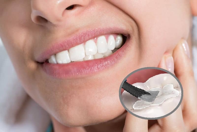 Trám răng cho người trưởng thành - Quy trình và giá thành mới nhất 2024