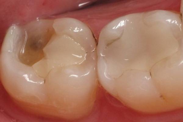 Trám răng cho người trưởng thành - Quy trình và giá thành mới nhất 2024