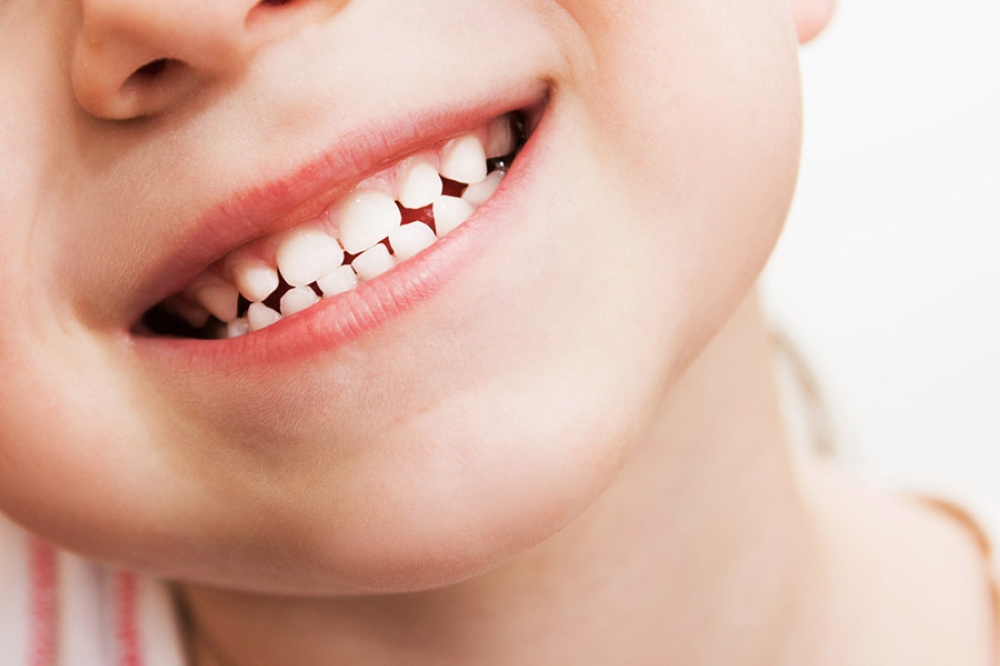 Trám răng cho trẻ em và 5 điều cha mẹ cần biết