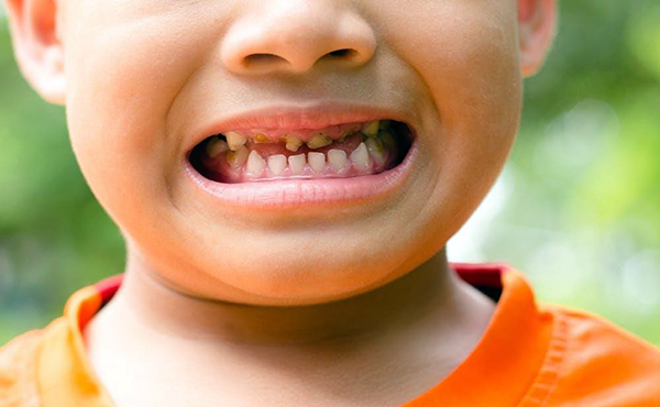 Trám răng cho trẻ em và 5 điều cha mẹ cần biết