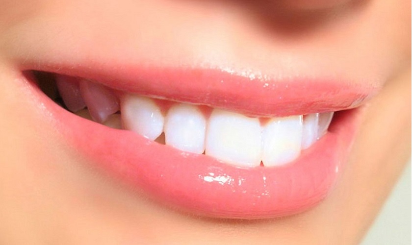 Trám răng cửa bao nhiêu tiền và quy trình 3 bước chuẩn y tế