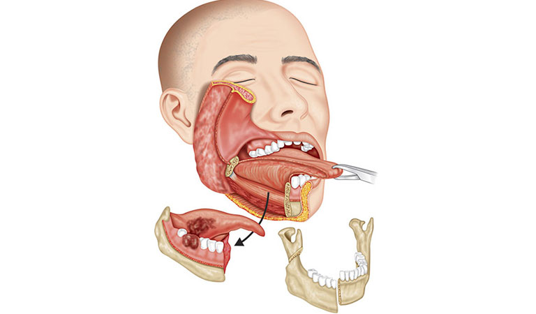 Đau xương hàm: Nguyên nhân, triệu chứng và 3 cách điều trị