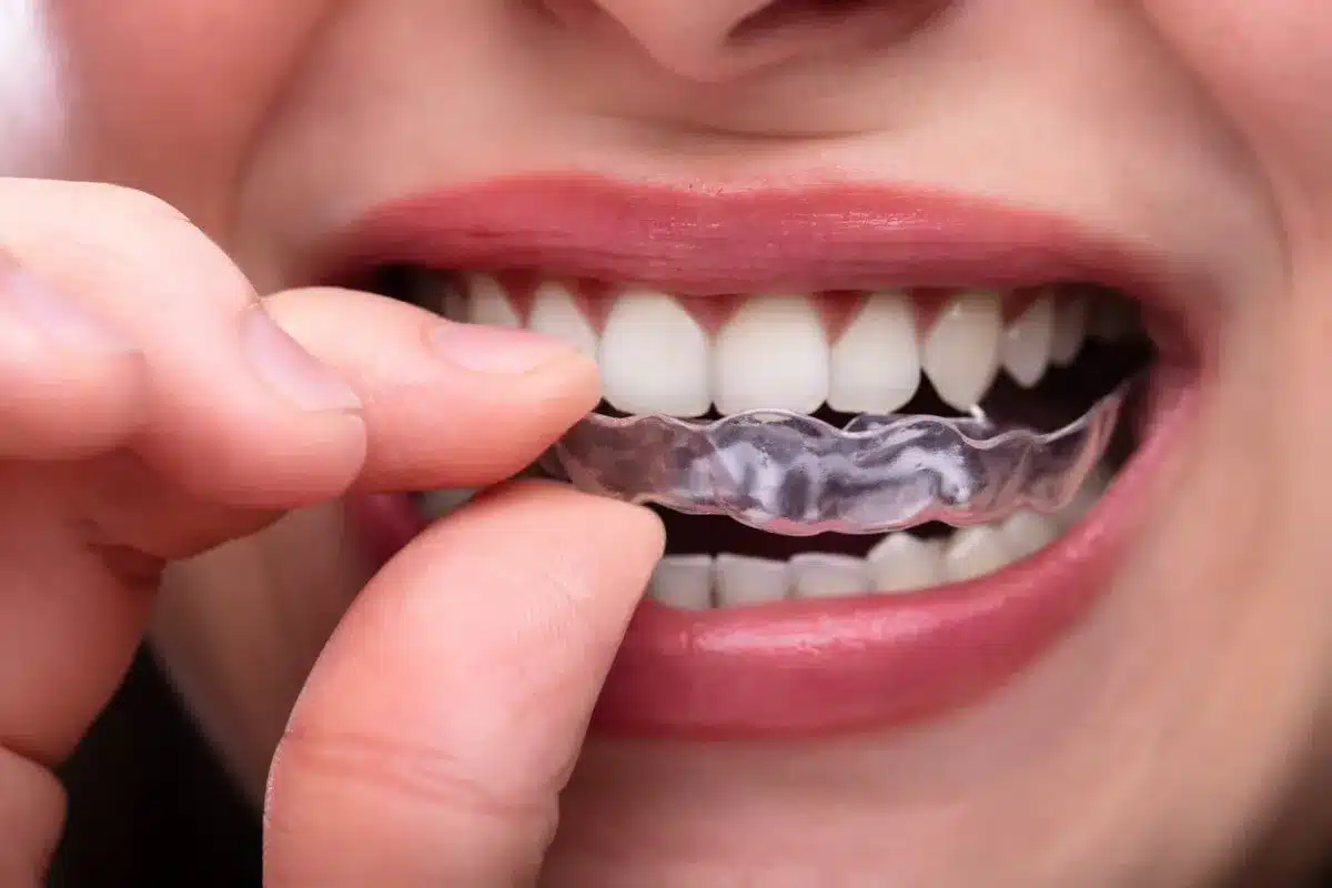 Máng chống nghiến: Giải pháp bảo vệ răng hiệu quả