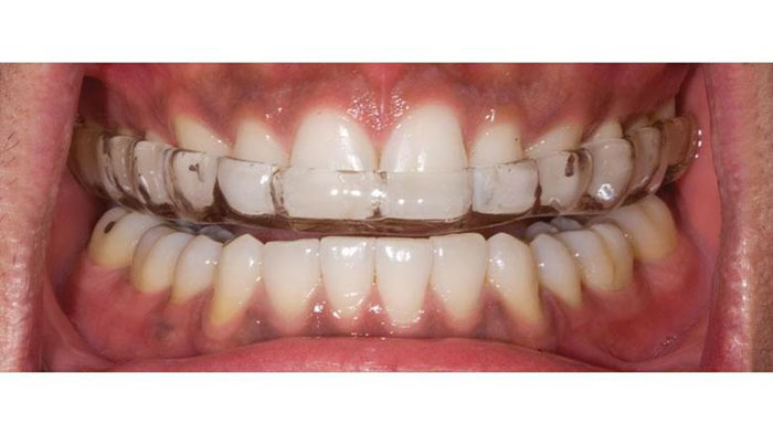 Máng chống nghiến: Giải pháp bảo vệ răng hiệu quả