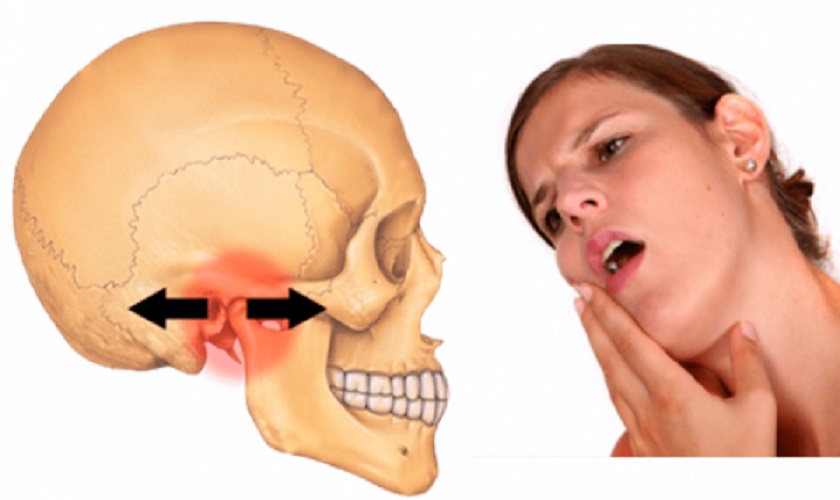 Máng chống nghiến: Giải pháp bảo vệ răng hiệu quả